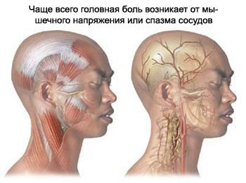 Migraine and tension-type headache - most common headache types occurrence in patients.